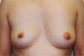 Patient # 59934 Before Photo # 1