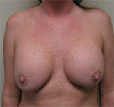Patient # 51764 Before Photo # 1