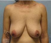 Patient # 36107 Before Photo # 1