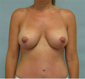 Patient # 61319 After Photo # 2