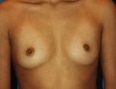 Patient # 59885 Before Photo # 1