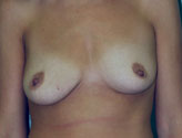 Patient # 97941 Before Photo # 1
