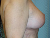 Patient # 26843 After Photo # 2