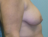 Patient # 26843 Before Photo # 1