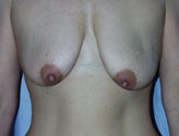Patient # 28560 Before Photo # 1