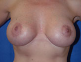 Patient # 59624 After Photo # 2