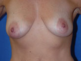 Patient # 59624 Before Photo # 1