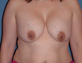 Patient # 27669 Before Photo # 1