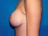 Patient # 53205 After Photo # 4