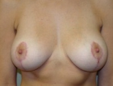 Patient # 34753 After Photo # 2