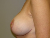 Patient # 34753 After Photo # 10