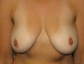 Patient # 34753 Before Photo # 1