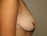 Patient # 34753 Before Photo # 7