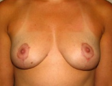 Patient # 25938 After Photo # 2