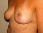Patient # 25938 After Photo # 6
