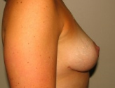 Patient # 25938 After Photo # 8
