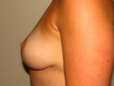 Patient # 25938 After Photo # 10