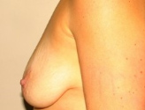 Patient # 25938 Before Photo # 9