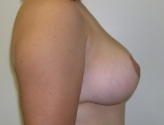 Patient # 49680 After Photo # 8