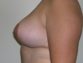 Patient # 49680 After Photo # 10
