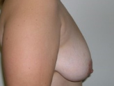 Patient # 49680 Before Photo # 7
