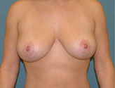 Patient # 17261 After Photo # 2
