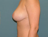 Patient # 17261 After Photo # 8