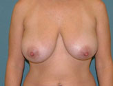 Patient # 17261 Before Photo # 1