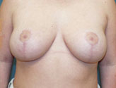 Patient # 49893 After Photo # 2