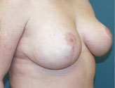 Patient # 49893 After Photo # 4