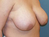 Patient # 49893 Before Photo # 3