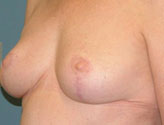 Patient # 61699 After Photo # 6