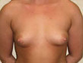 Patient # 27150 Before Photo # 1