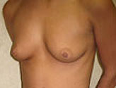 Patient # 34555 Before Photo # 1