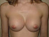 Patient # 40480 After Photo # 2