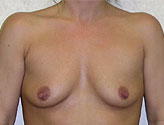 Patient # 89683 Before Photo # 1