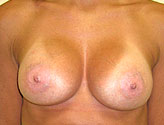 Patient # 26384 After Photo # 2