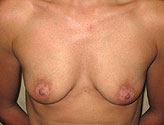 Patient # 26384 Before Photo # 1