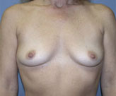 Patient # 23193 Before Photo # 1