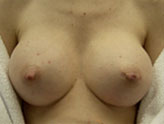 Patient # 81437 After Photo # 2