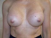 Patient # 92744 After Photo # 2