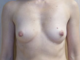 Patient # 92744 Before Photo # 1