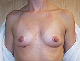 Patient # 20429 Before Photo # 1