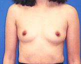 Patient # 83516 Before Photo # 1