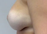 Patient # 13693 After Photo # 4