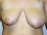 Patient # 13693 Before Photo # 1