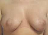 Patient # 96140 After Photo # 2