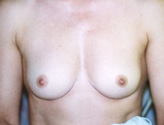 Patient # 62593 Before Photo # 1