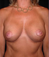 Patient # 51681 After Photo # 2
