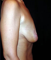 Patient # 51681 Before Photo # 3